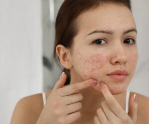 טיפול באקנה